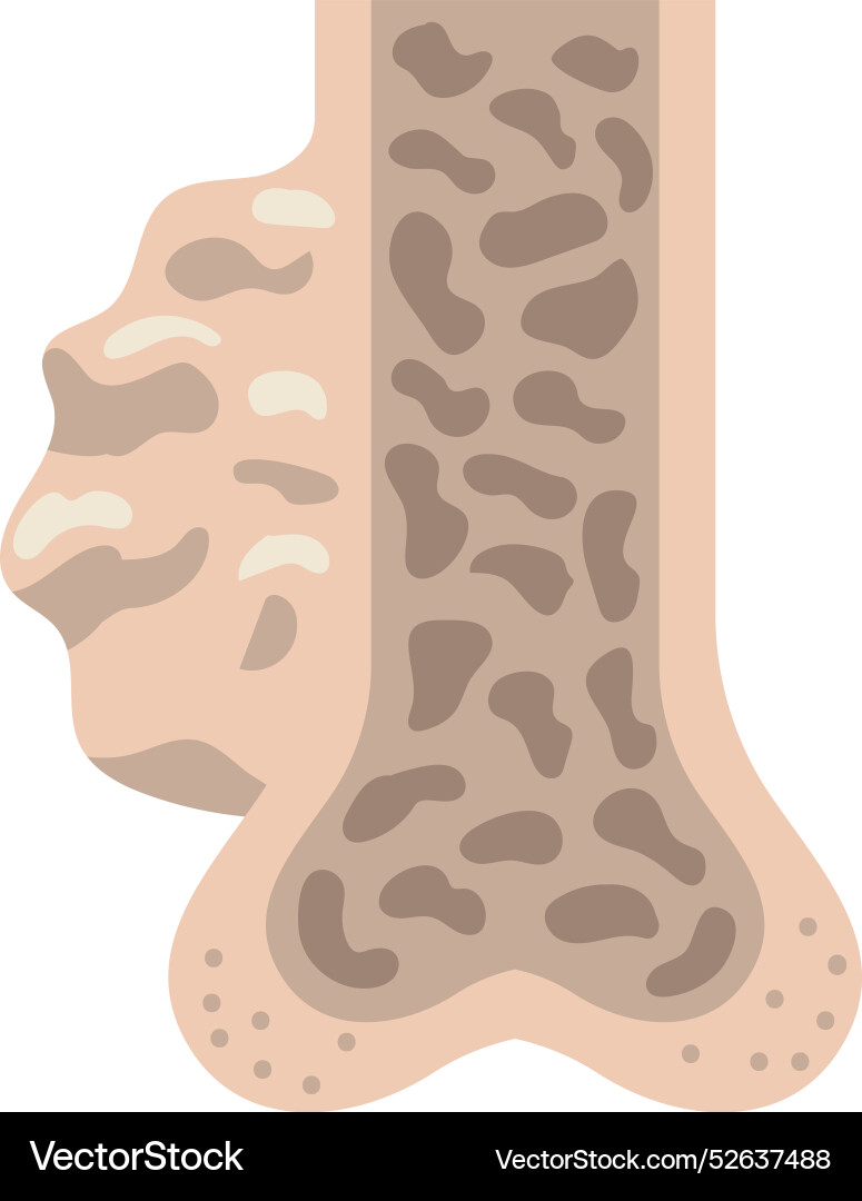 Multiple Myeloma Cross Section Of Bones Royalty Free Vector