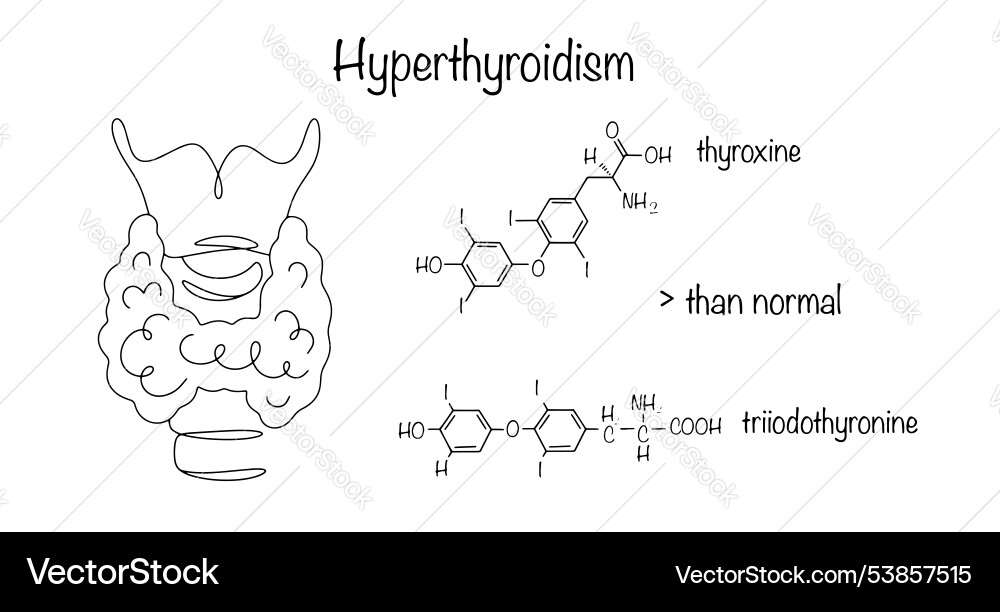 Hyperthyroidism Hyperthyroidism Vector Image