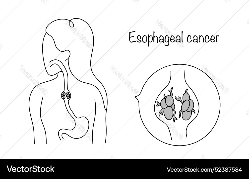 Esophageal cancer Royalty Free Vector Image - VectorStock