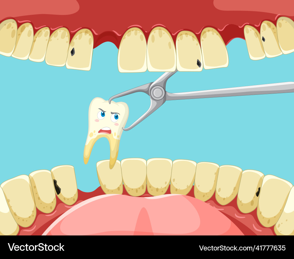 Tooth extraction inside human mouth vector image