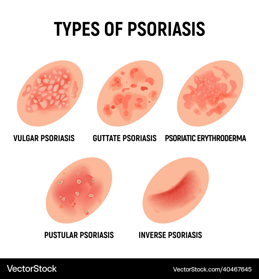 Psoriasis Rash on Hand Vector Image