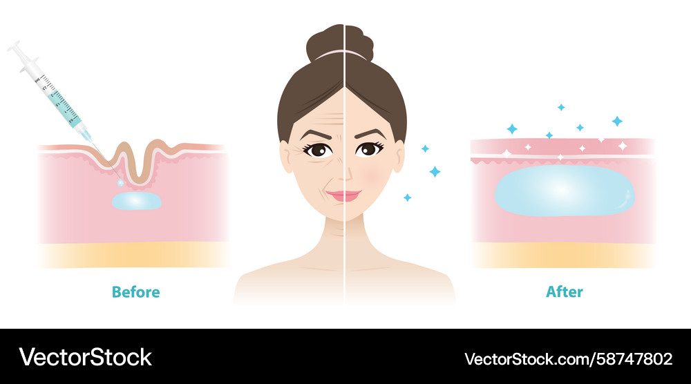 Before & After Filler Injection - Facial Correctio Vector Image