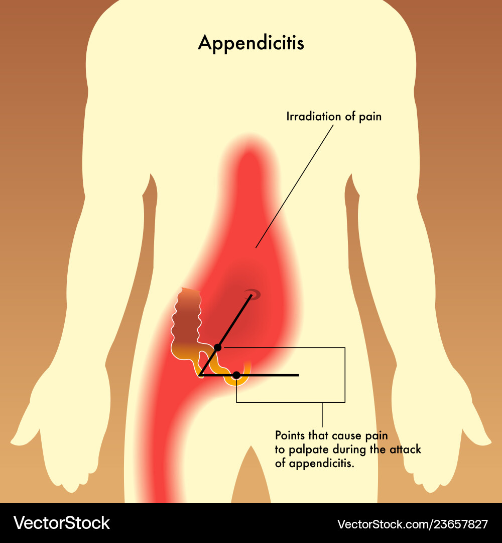 Appendix pain points Appendix pain points vector image