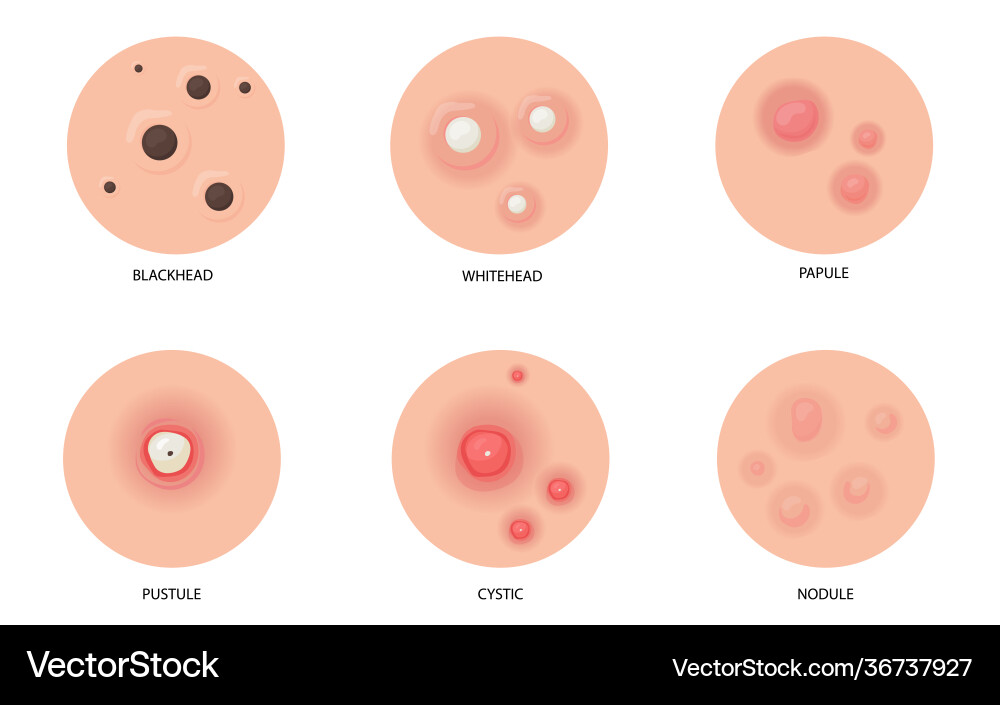 Different types acne flat set for web design Vector Image