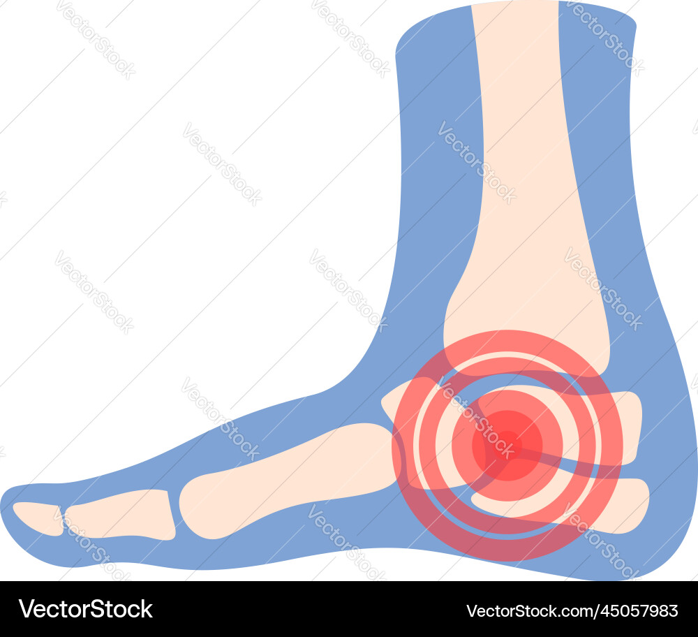 Fersenschmerzen Ikone Cartoon Arthritis Gelenk Fersenschmerzen Ikone Cartoon Arthritis Gelenk vektorbild