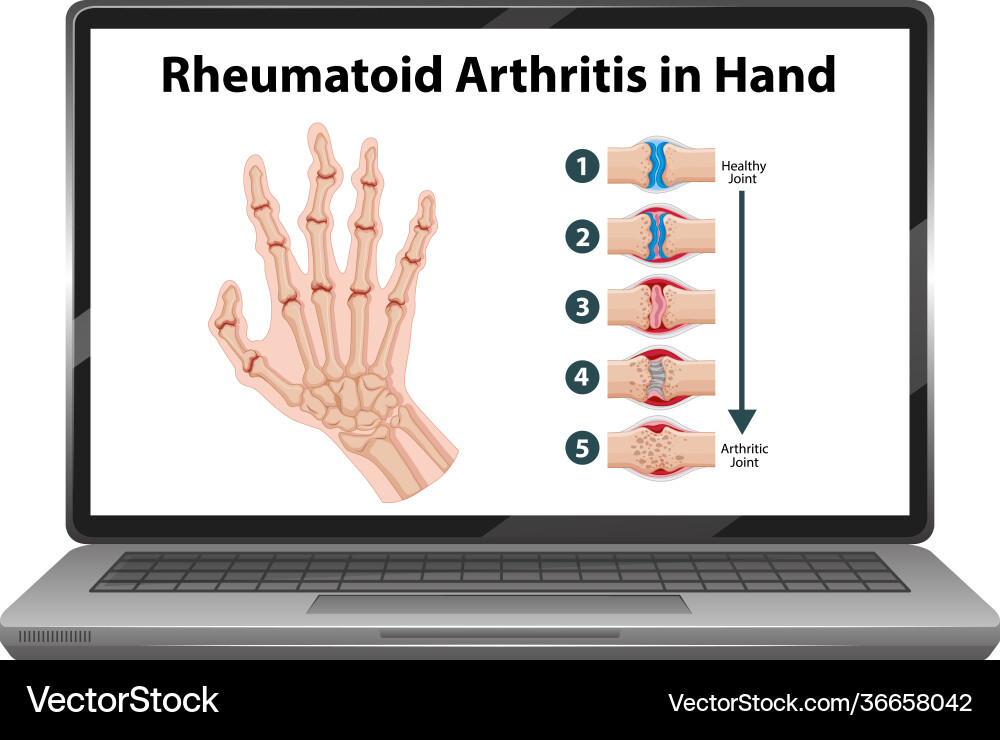 Rheumatoid arthritis symptoms on hand laptop vector image