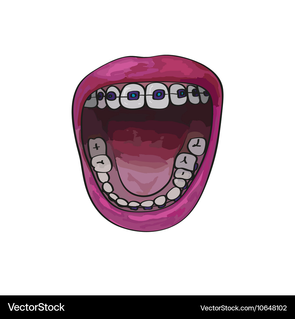 Cartoon Open Mouth mit Klammern Vektorbild