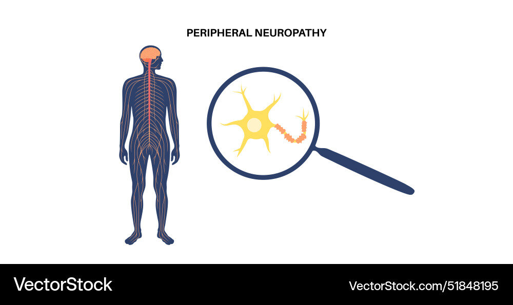 Peripheral neuropathy medical poster Peripheral neuropathy medical poster vector image