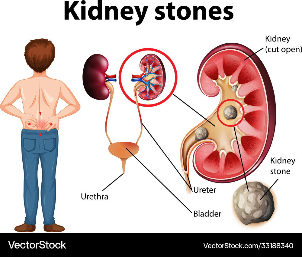 Comparison healthy kidney Comparison healthy kidney vector image