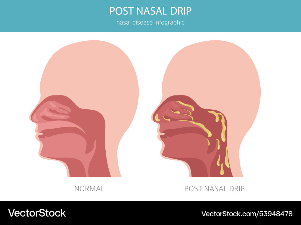 Post nasal drip diseases medical Post nasal drip diseases medical vector image