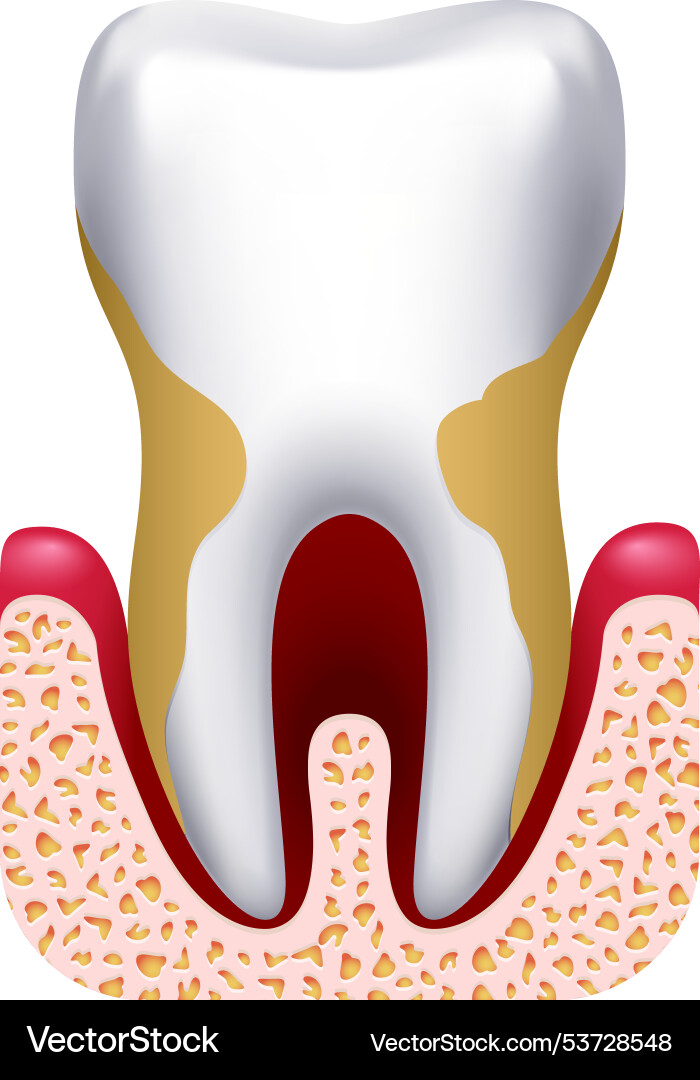 Periodontitis drawing dental clinic treatment Periodontitis drawing dental clinic treatment vector image