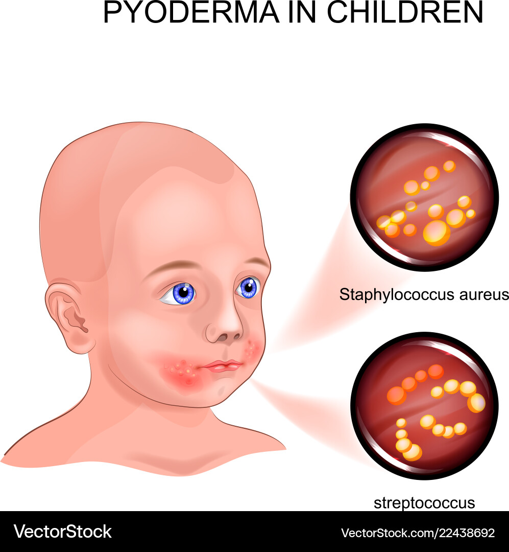 Pyoderma in child Pyoderma in child Vector Image
