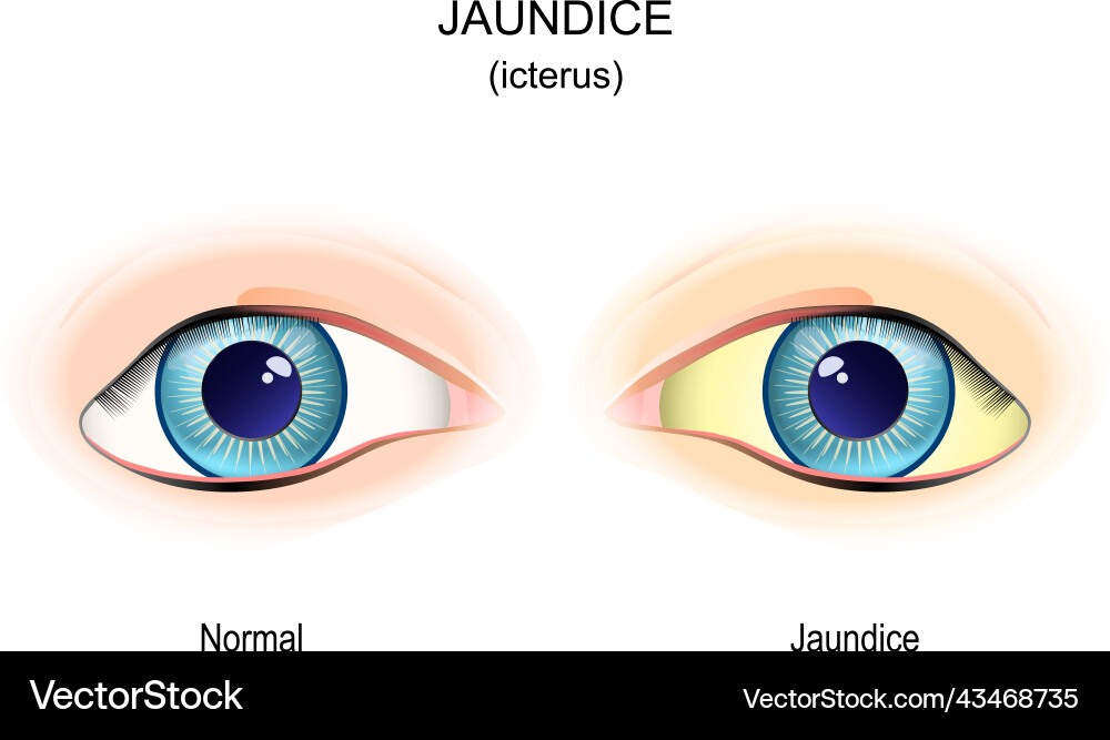 https://cdn.vectorstock.com/i/1000v/87/35/jaundice-comparison-normal-vs-icterus-vector-43468735.jpg