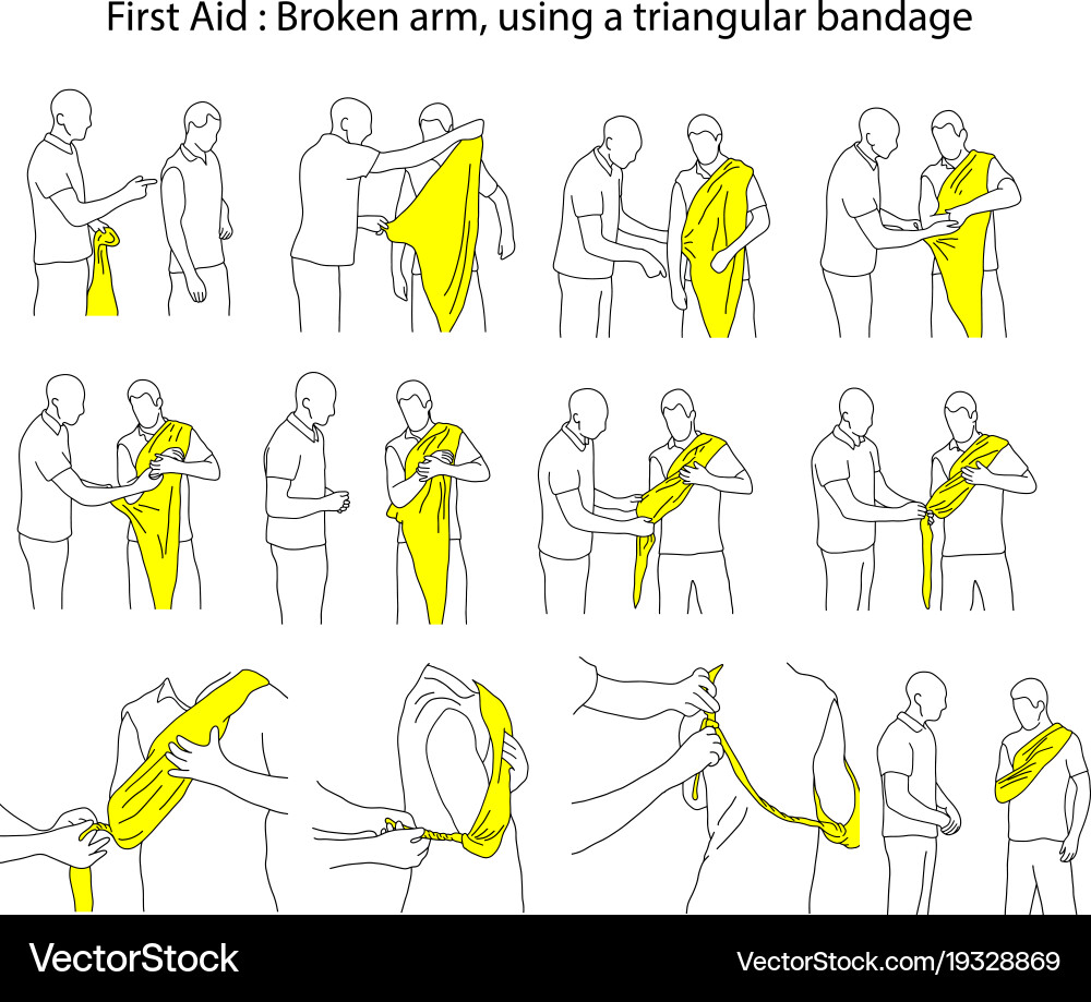 Broken arm using a triangular bandage vector image