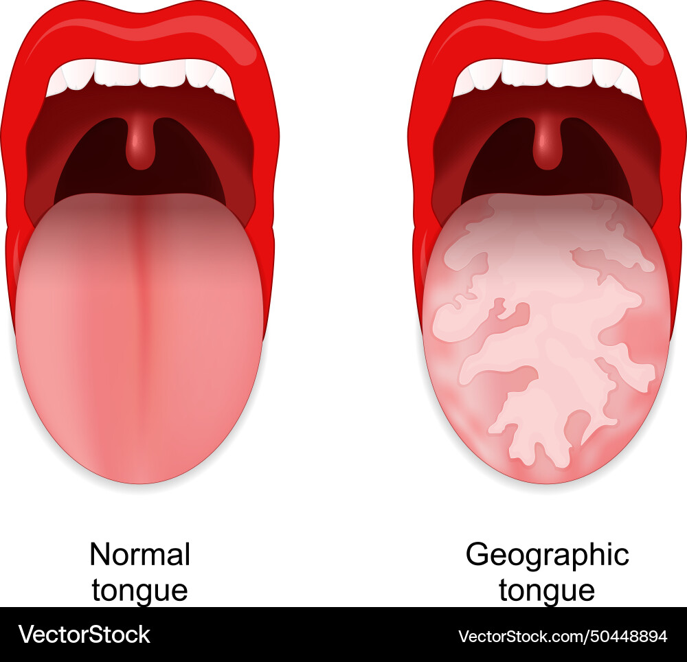 Geographic tongue benign migratory glossitis vector image