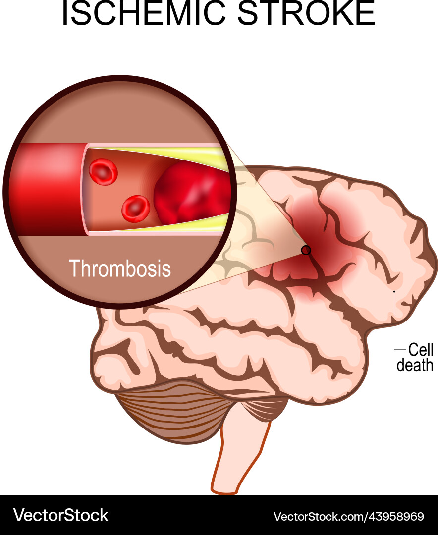 Ischemic stroke human brain Royalty Free Vector Image