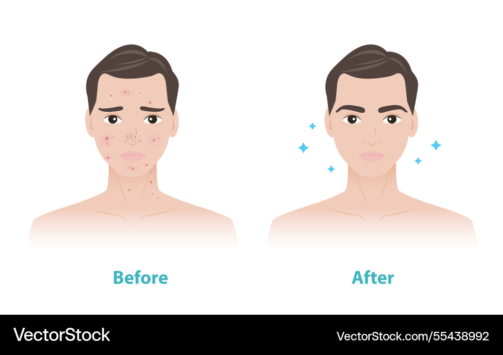 Comparison of man face before and after acne Comparison of man face before and after acne vector image