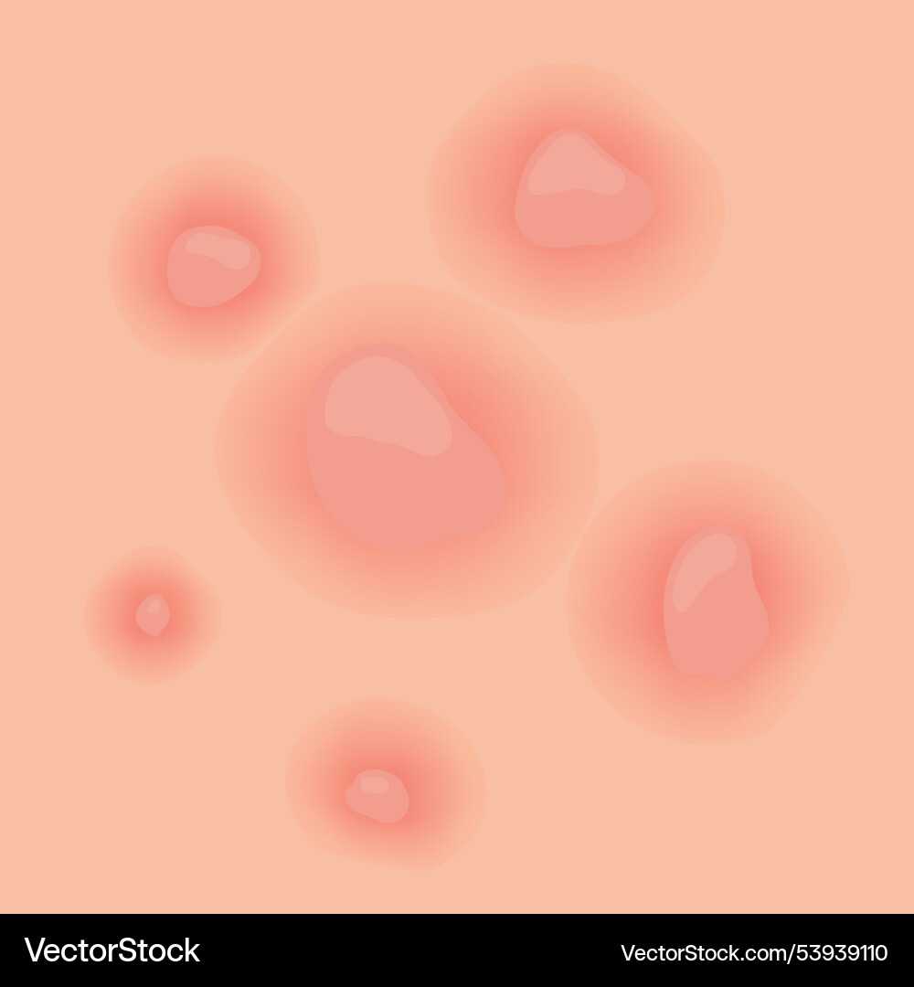 Understanding type of acne a comprehensive visual Understanding type of acne a comprehensive visual Vector Image