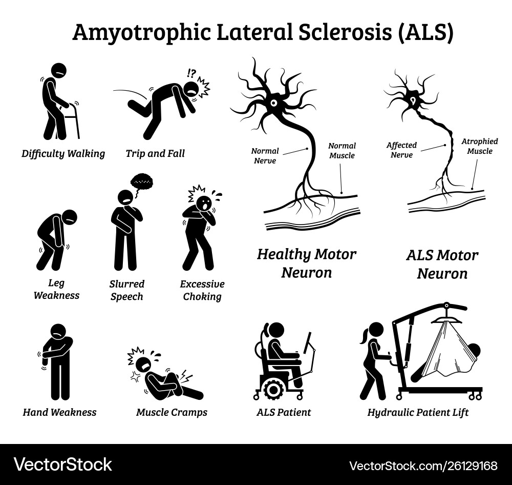 Amyotrophic lateral sclerosis als disease signs Vector Image