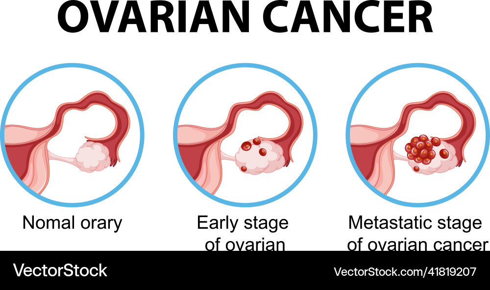 Ovarian cancer development process infographic Ovarian cancer development process infographic vector image