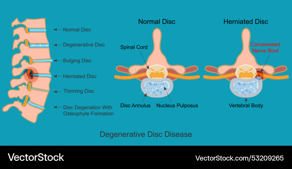 Degenerative disc disease is a fragment Royalty Free Vector