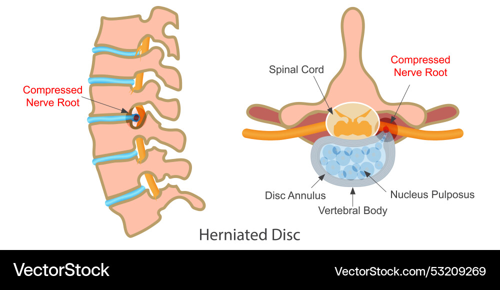 Herniated disk is a condition that can occur vector image