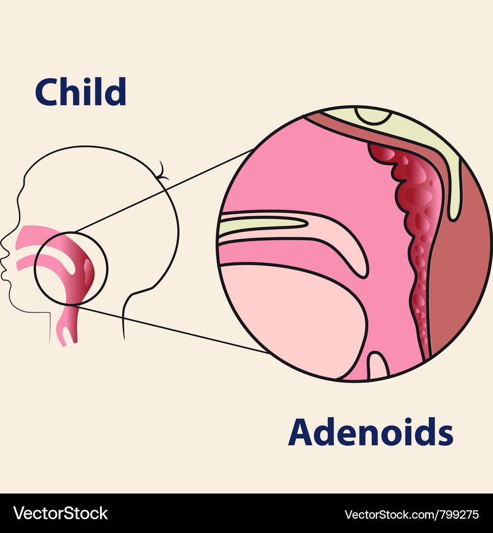 Adenoide in einem medizinischen Kinderplakat Vektorbild