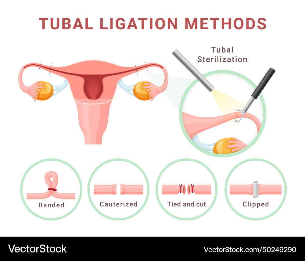 Tuballigisationsverfahren weibliche Sterilisation Tuballigisationsverfahren weibliche Sterilisation vektorbild
