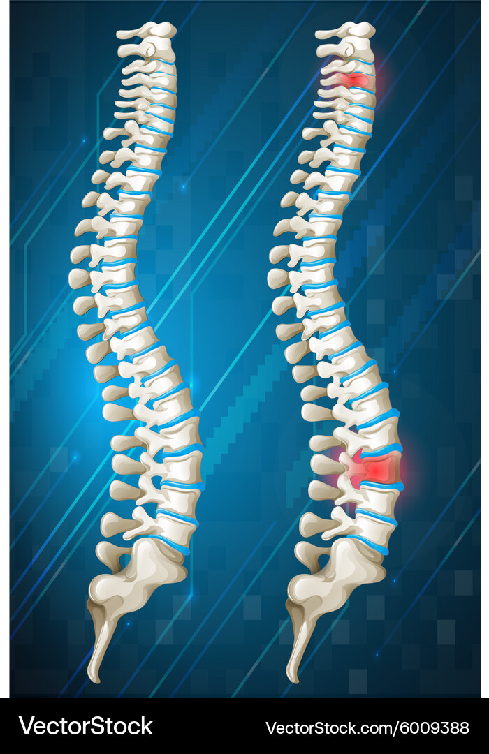 Inflamed Spine Anatomy - Medical Illustration Vector Image