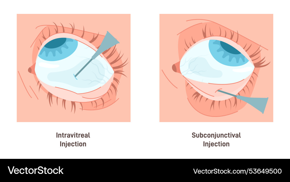 Eyes injection types intravitreal Vector Image
