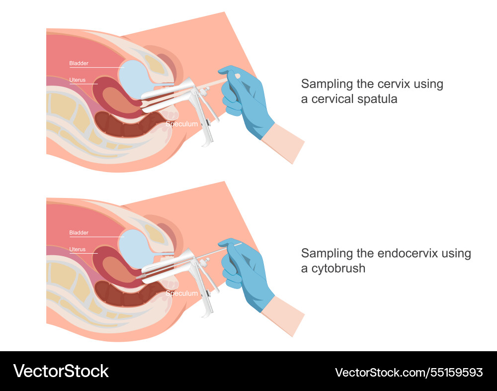 Sampling the endocervix using endocervical Sampling the endocervix using endocervical vector image