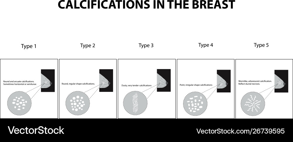 Classification calcifications in mammary Classification calcifications in mammary vector image