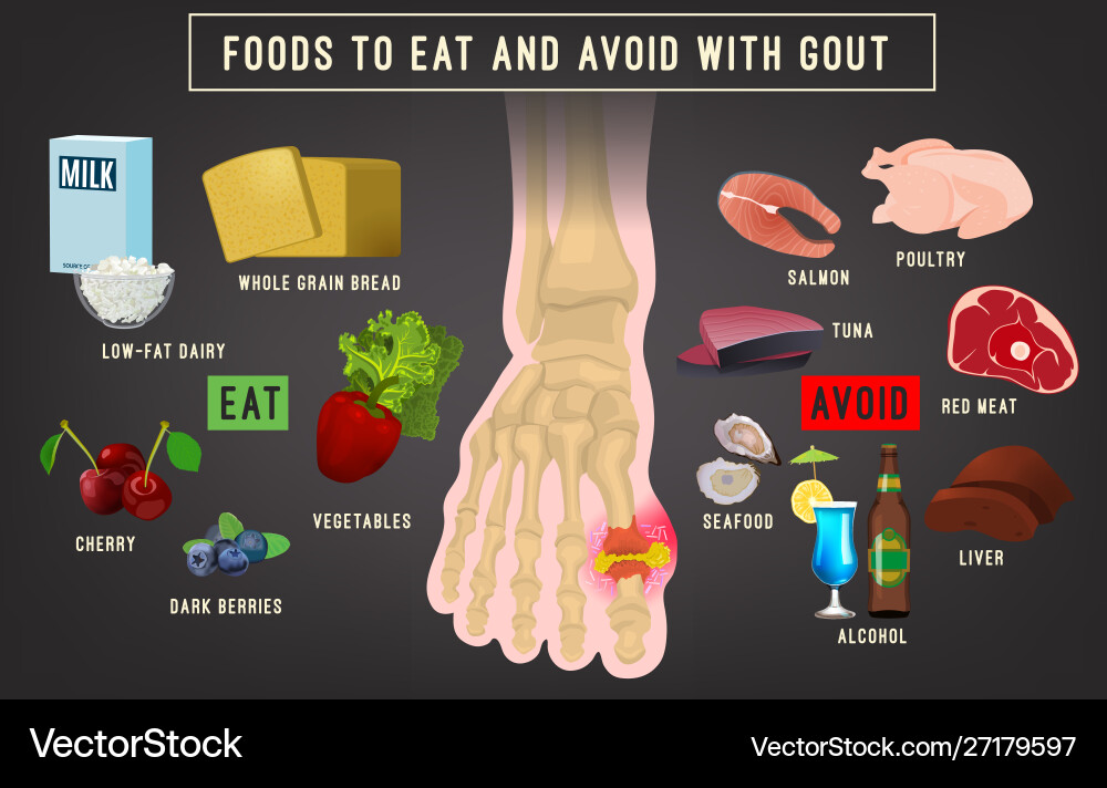 Gout arthritis infographic vector image