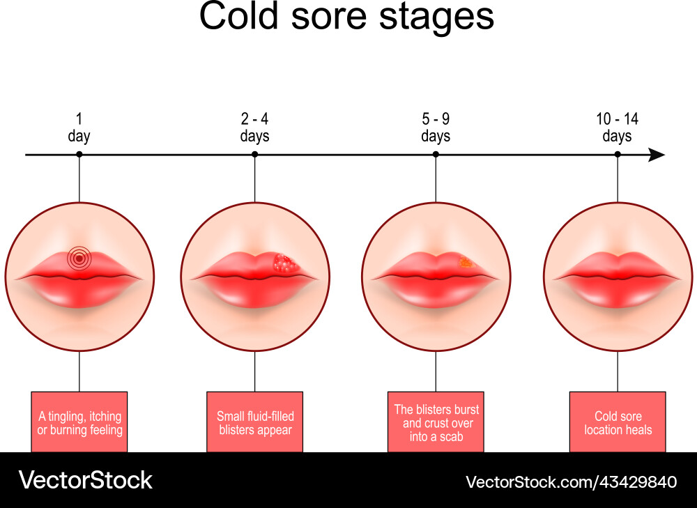 Cold sore stages lips with symptoms of herpes Cold sore stages lips with symptoms of herpes vector image