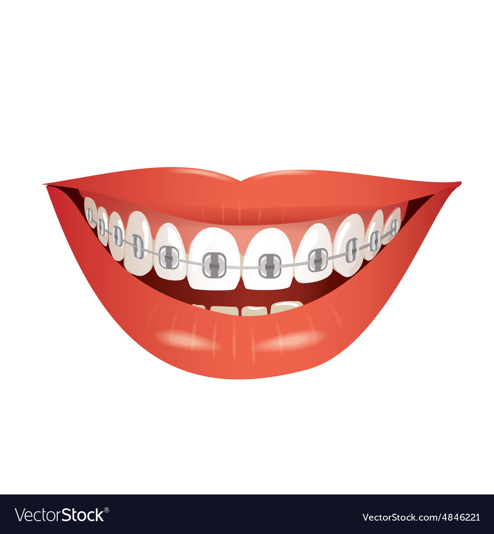 Download Smiling mouth with braces isolated Royalty Free Vector ...