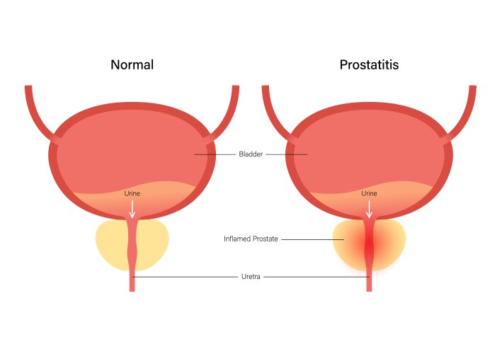 prostatitis inflammation problem vector image