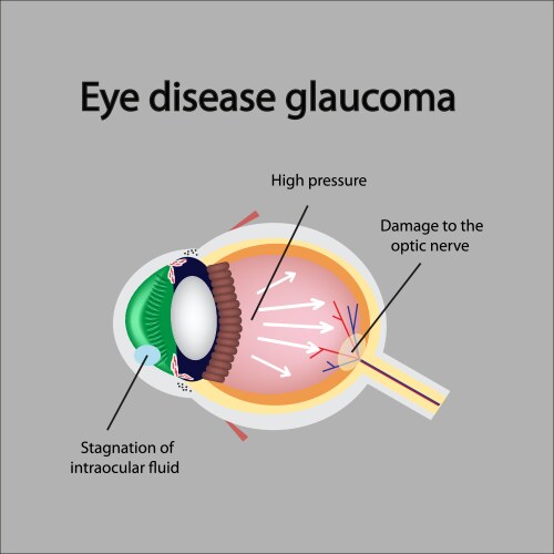 Glaucoma the structure of eye field Royalty Free Vector