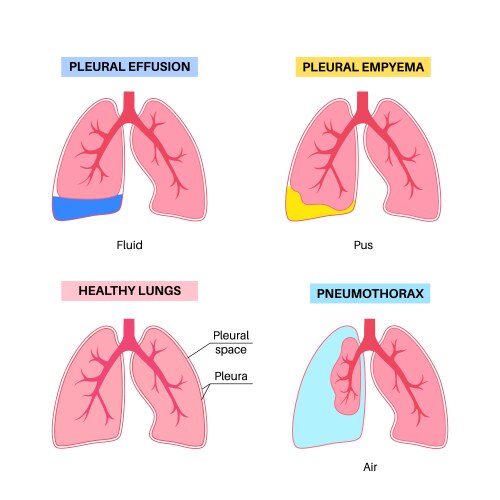 pleural effusion poster vector image