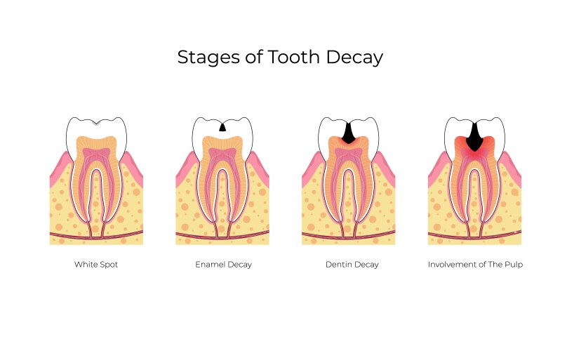 Human in the stages of tooth decay Royalty Free Vector Image
