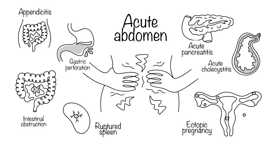 Acute Pancreatitis Vector Images (over 120)