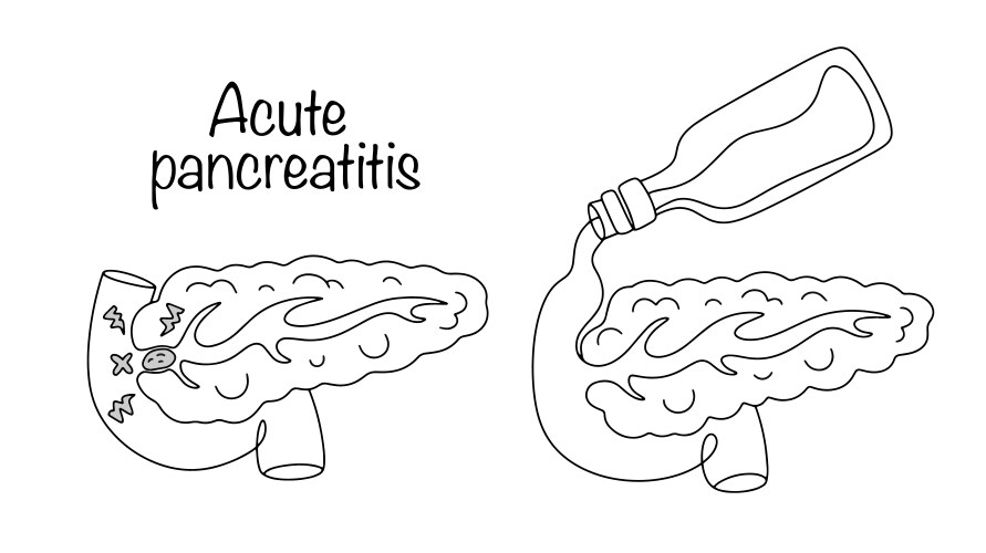 Acute Pancreatitis Vector Images (over 120)
