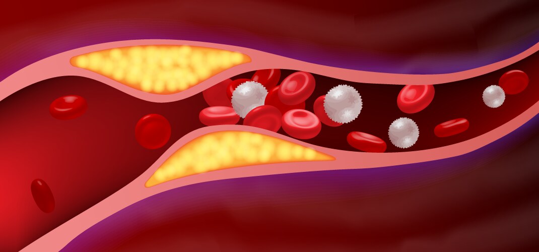 arteries with clogged fat that causes blood clots vector