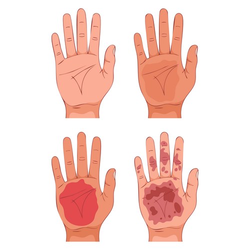 Human Hand Burn Degrees of Severity – Royalty-Free Vector | VectorStock