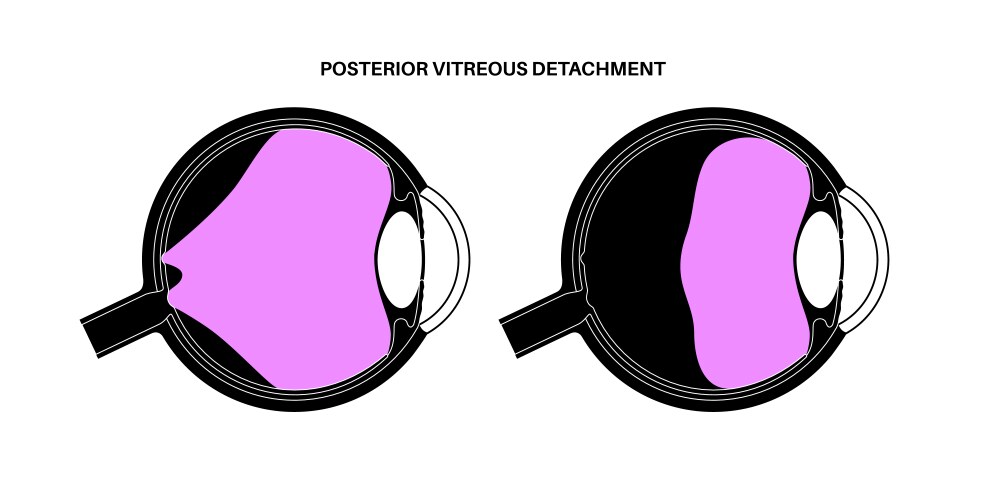 Vitreous hemorrhage poster Royalty Free Vector Image