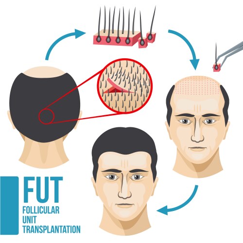 male hair loss treatment medical vector