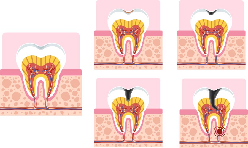 Tooth Cross Section Vector Images (over 180)