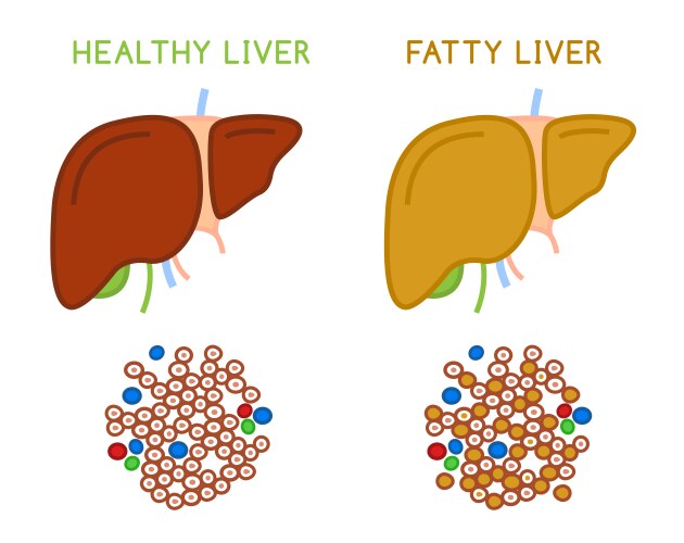 Healthy and fatty liver medical vector image