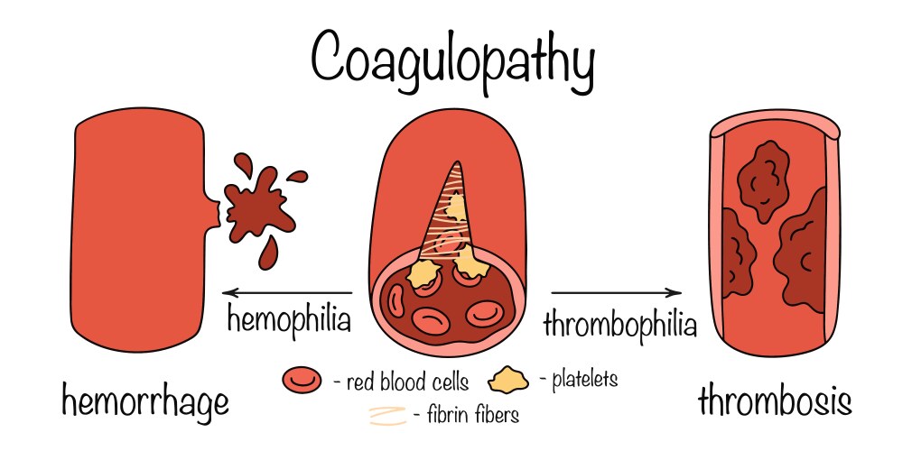 Blood Clotting Process Infographic – Royalty-Free Vector | VectorStock