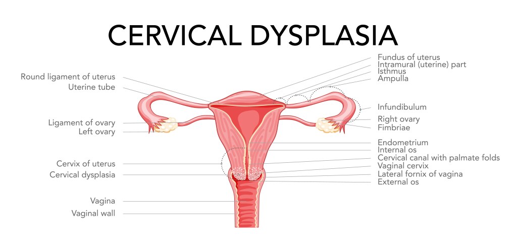 Cervical cancer diagram with inscriptions in latin vektorbild