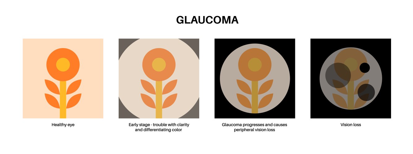 Glaucoma eye disease Royalty Free Vector Image